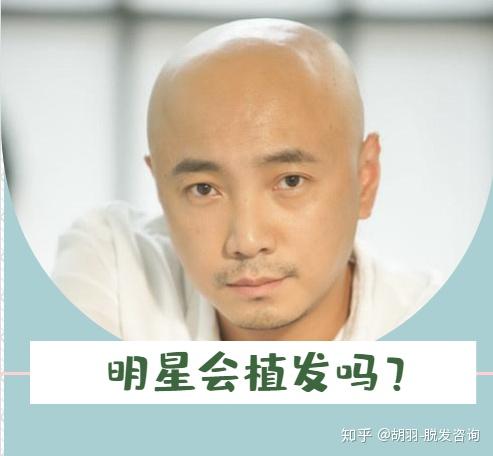 揭秘明星不植发的背后原因，温情与陪伴的秀发故事
